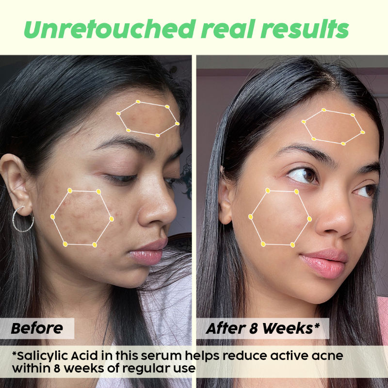 2% Salicylic Acid Jamun Active Acne Control Dewy Serum for Active Acne & Dark Spot Reduction