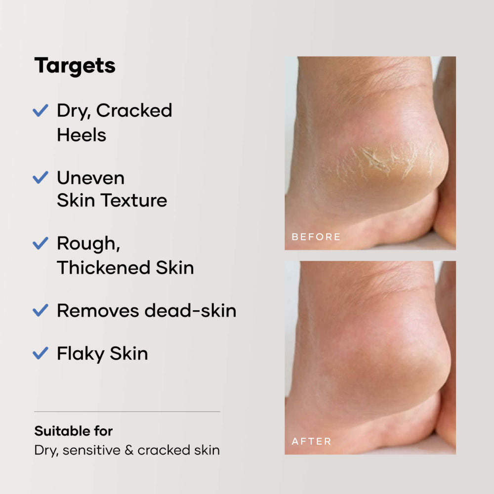 Foot Care Cream for Cracked Heels