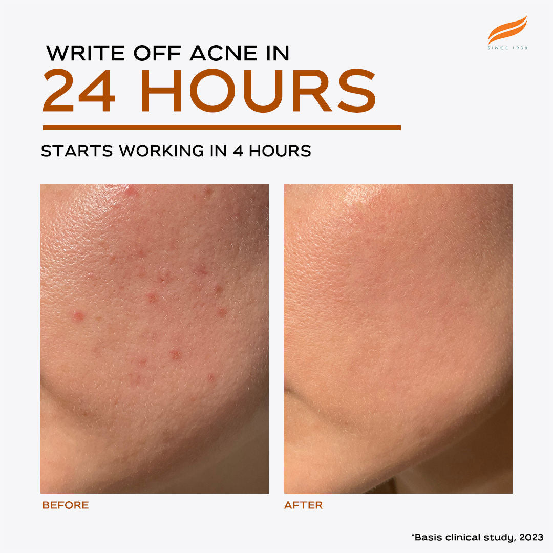 Acne Clear+ Spot Treatment Pen with 2% Natural Salicylic Acid Reducing Acne Size in 24 hrs