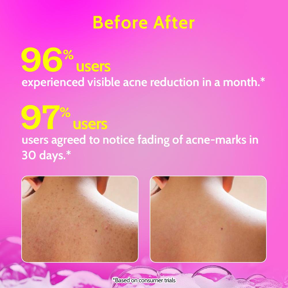 1% Salicylic Acid Acne Control Body Wash For Back And Body Acne And Back Acne