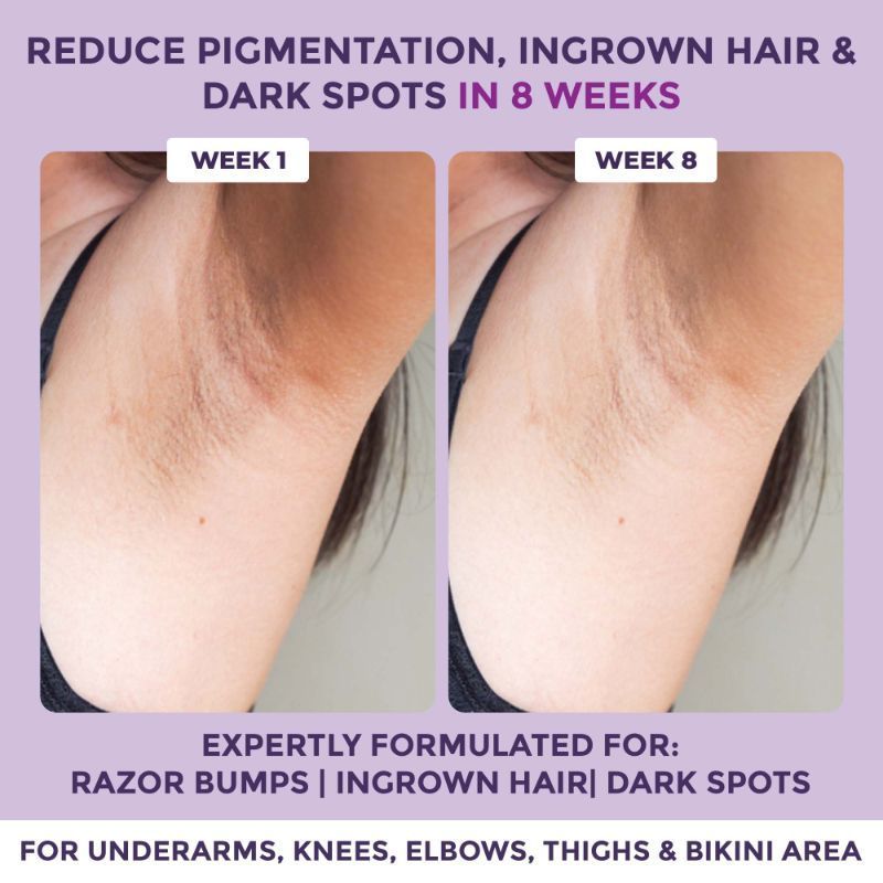 Spotlite Ingrown Hair & Bumps Clearing Body Scrub For Dark Underarms, 10% Glycolic Acid