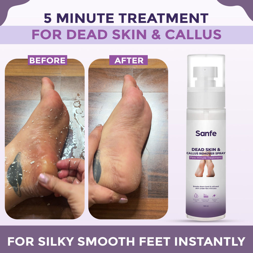 Dead Skin & Callus Remover Spray | Freshens, Exfoliates - For dry & cracked feet, 100ml
