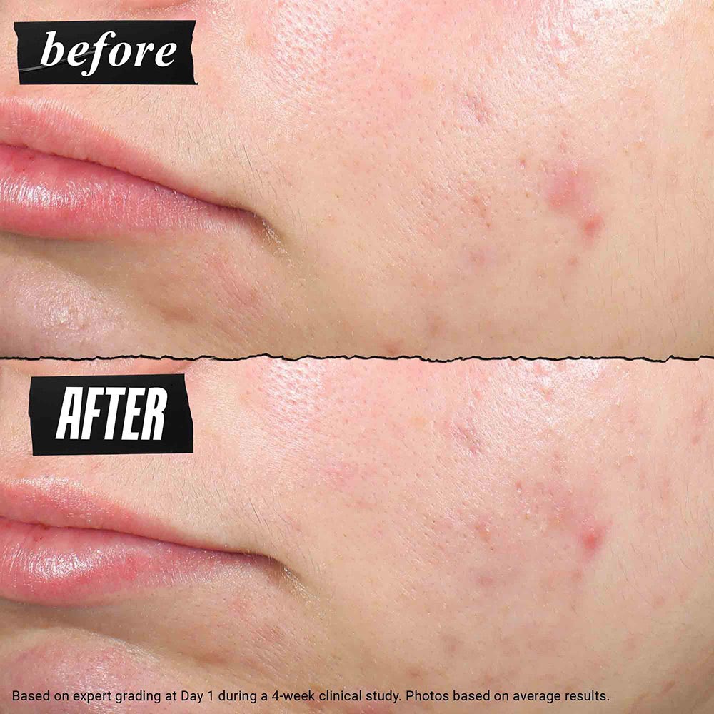 Kiehl’s Truly Targeted Blemish - Clearing Solution