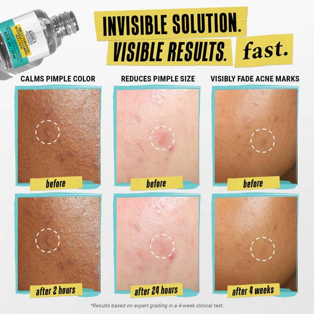 Kiehl’s Truly Targeted Blemish - Clearing Solution