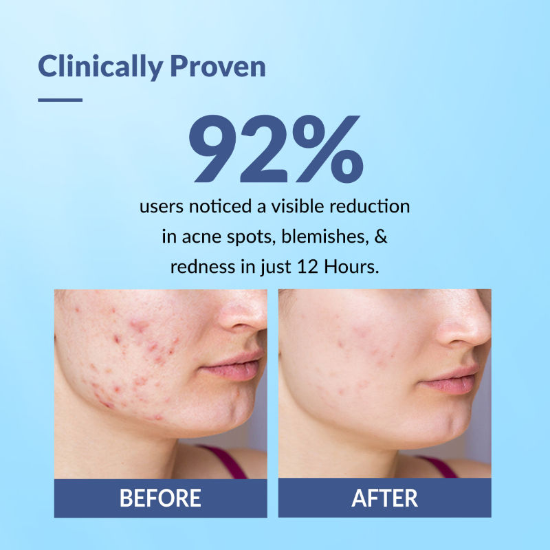 Salyzap 2% Salicylic Acid Acne Spot Corrector Gel with 2% Niacinamide Pimple Remover