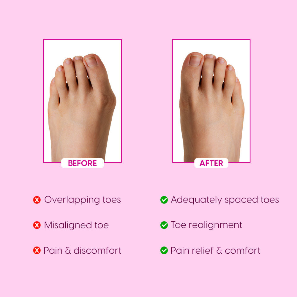 Toe Separators Silicone Gel Toe Straightener Spacer Pads Bunion Corrector Pedicure Tool
