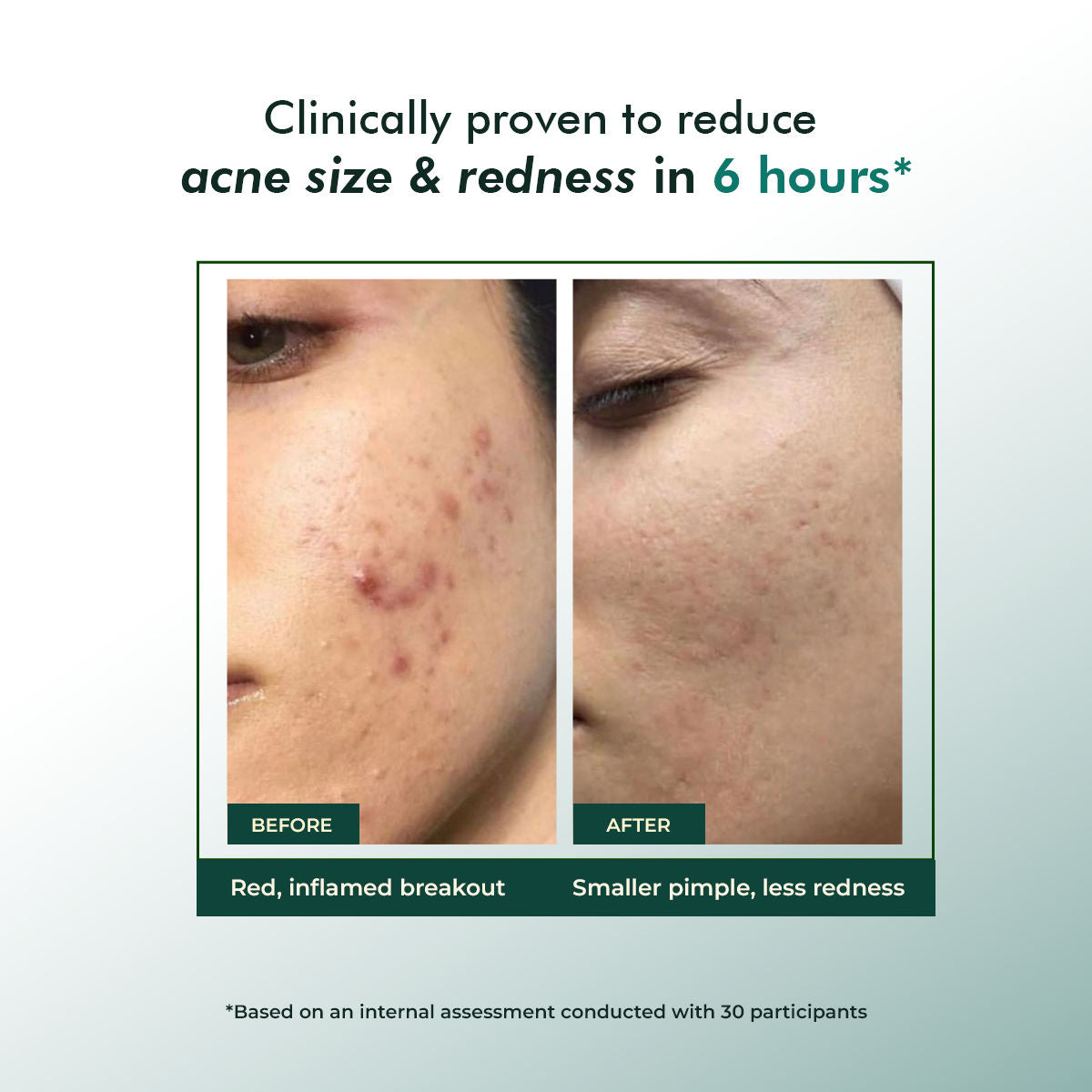 Rapid Relief Acne Spot Corrector Gel