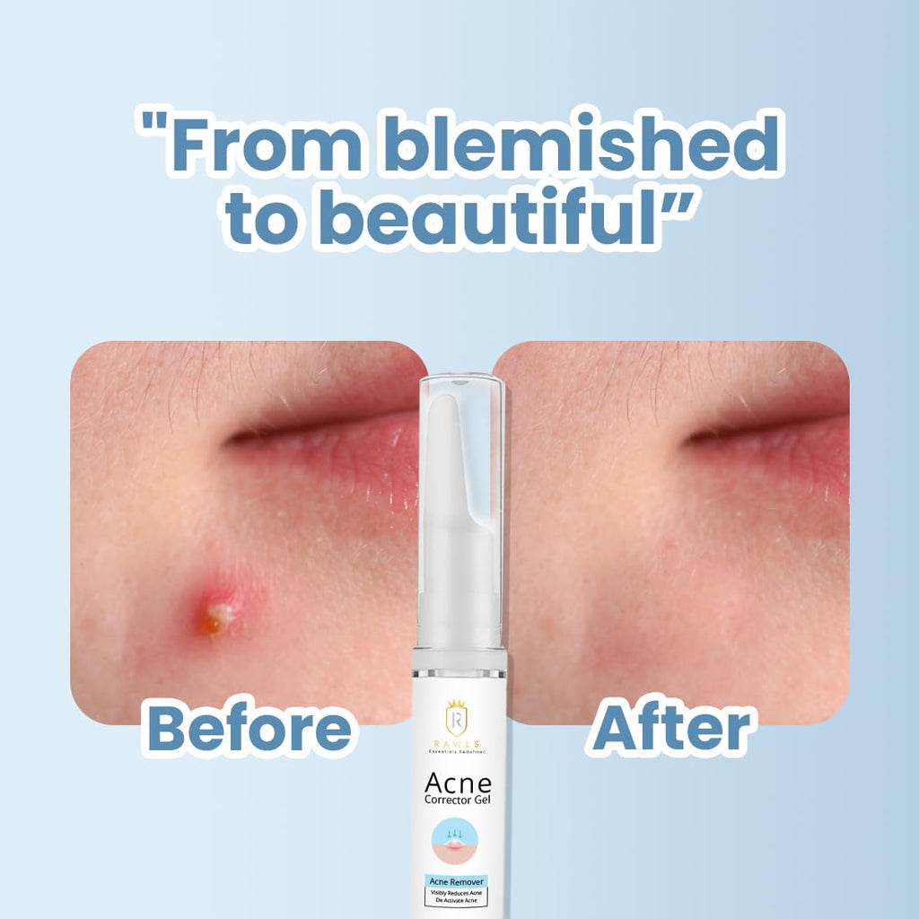 Acne Corrector Gel For Active Acne & Redness