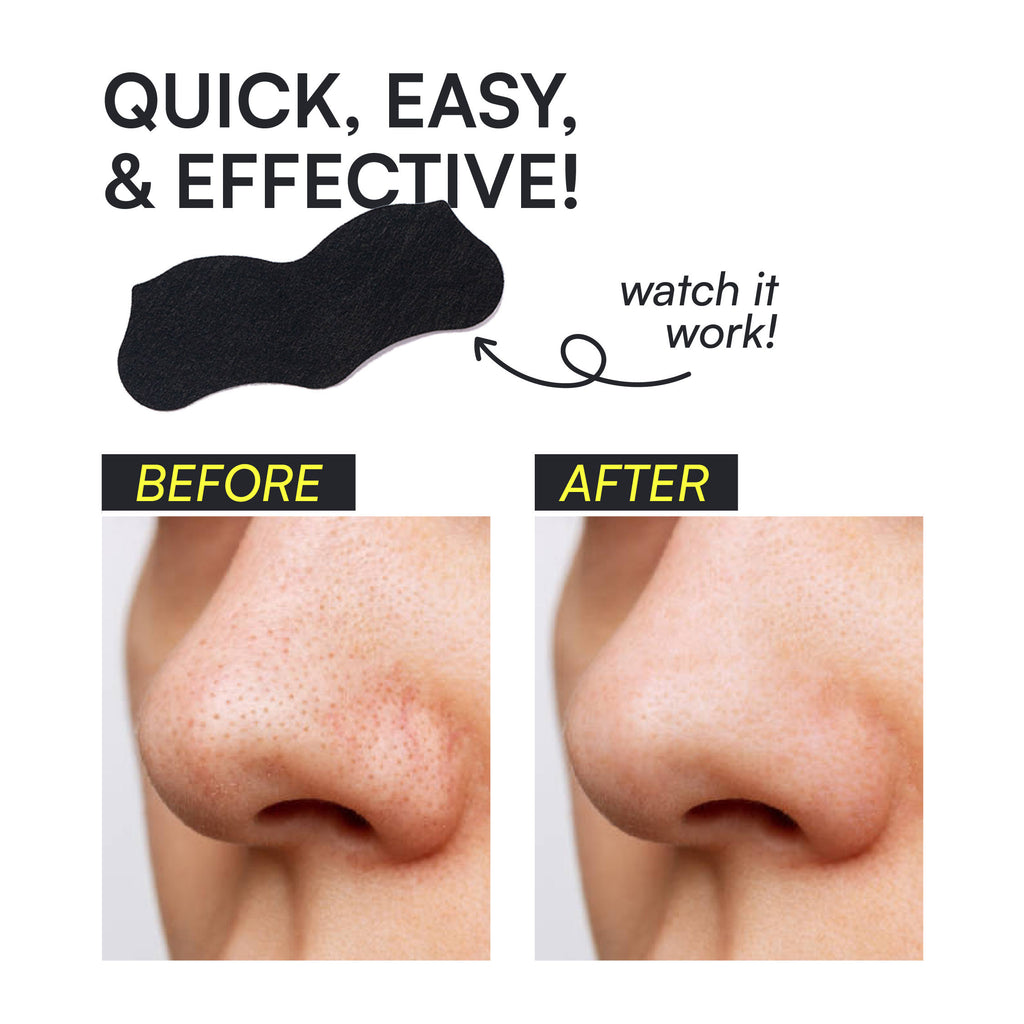 Nose Pore Patches - Charcoal
