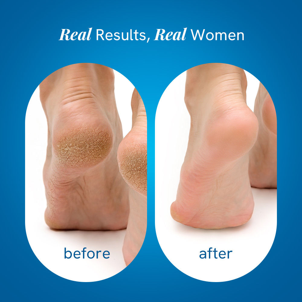 20% Urea Foot & Heel Roll On For Dry Feet & Cracked Heels With Urea & Lactic Acid