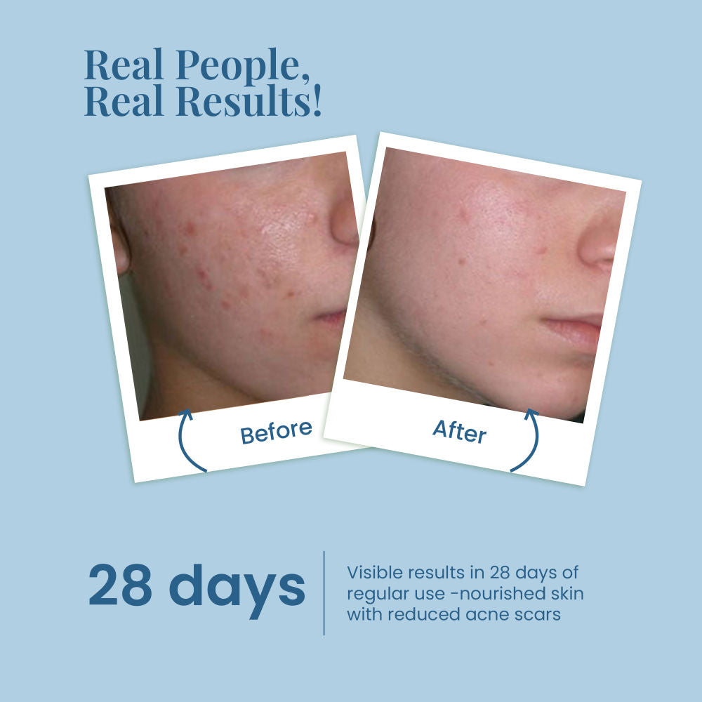Acne & Pore Perfection Face Serum Reduces Dark Spots & Scar, For Oily & Acne Prone Skin