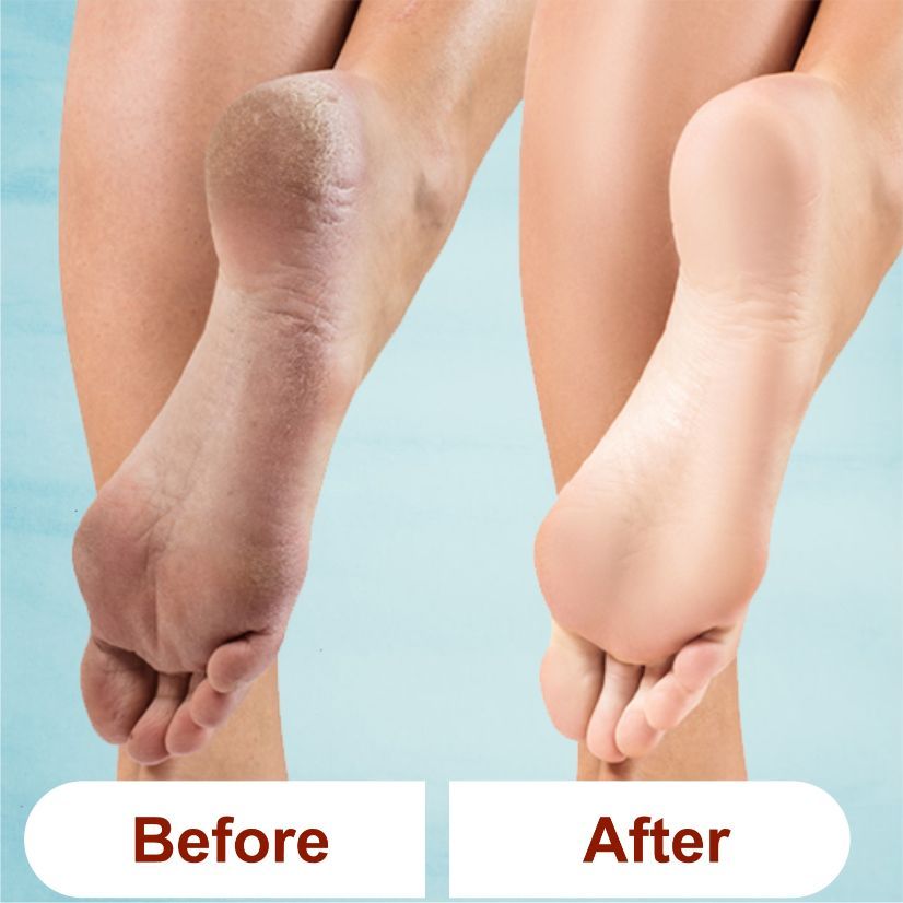 Tea Tree And Lemon Anti Bacterial Foot Scrub With Jojoba Oil - For Feet Nourishment