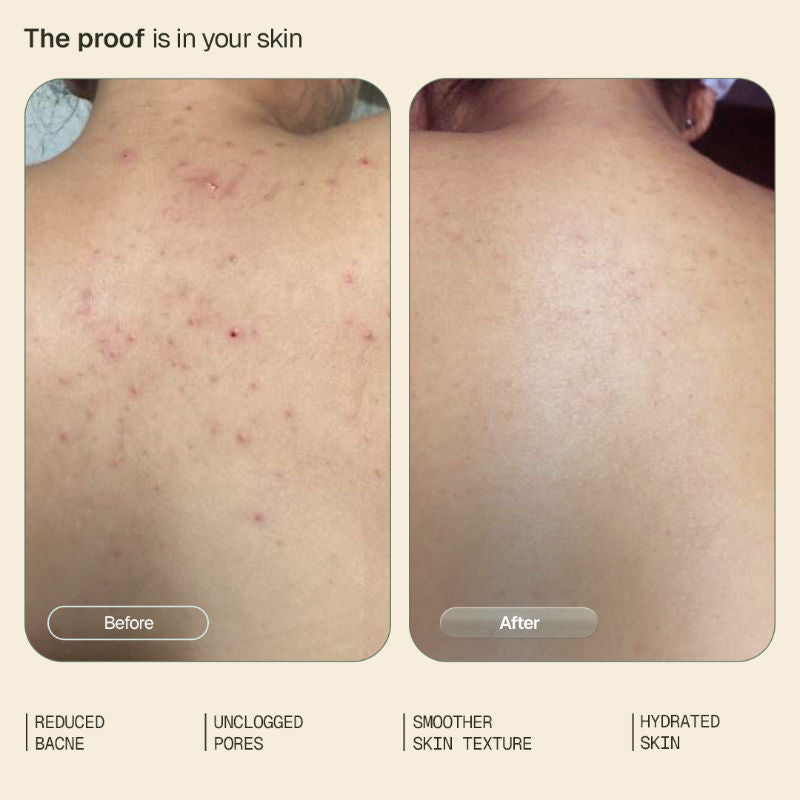 1% Salicylic Acid Daily Body Wash Exfoliates Clears Back Acne & Improves Strawberry Skin