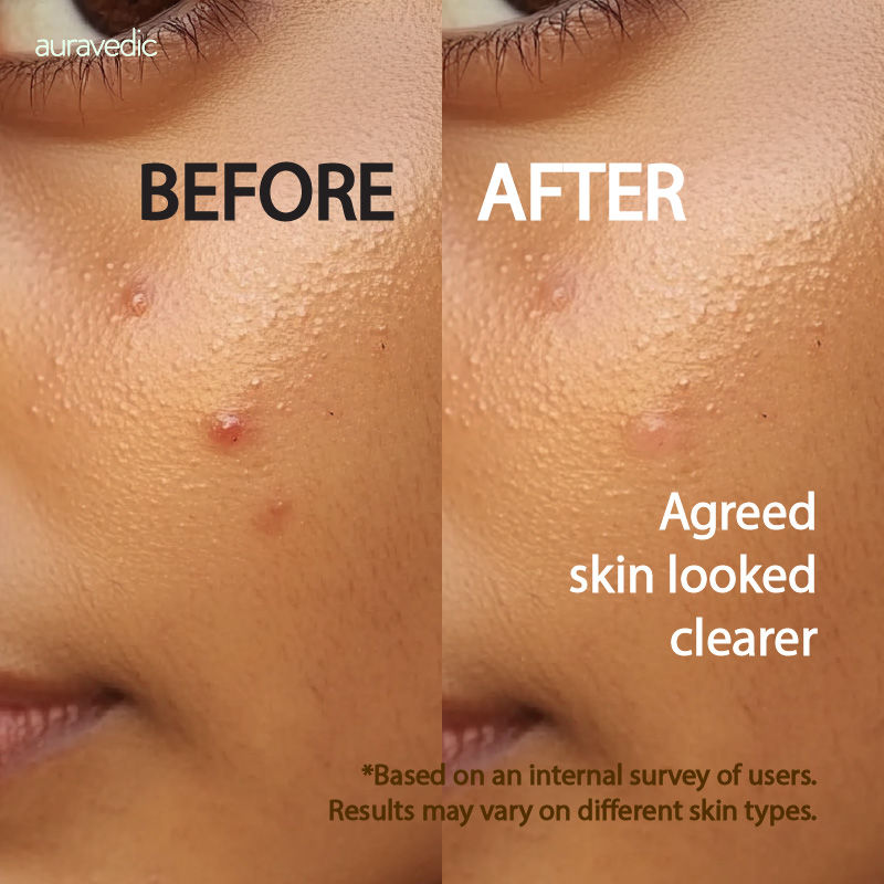 Neem & Tea Tree Face Wash For Oily And Acne Prone Skin Tea Tree Oil Salicylic Face Wash
