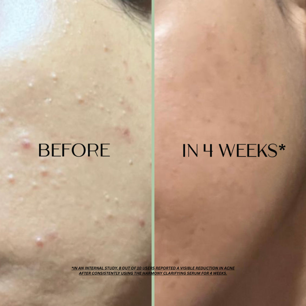 Harmony Azelaic Acid Serum