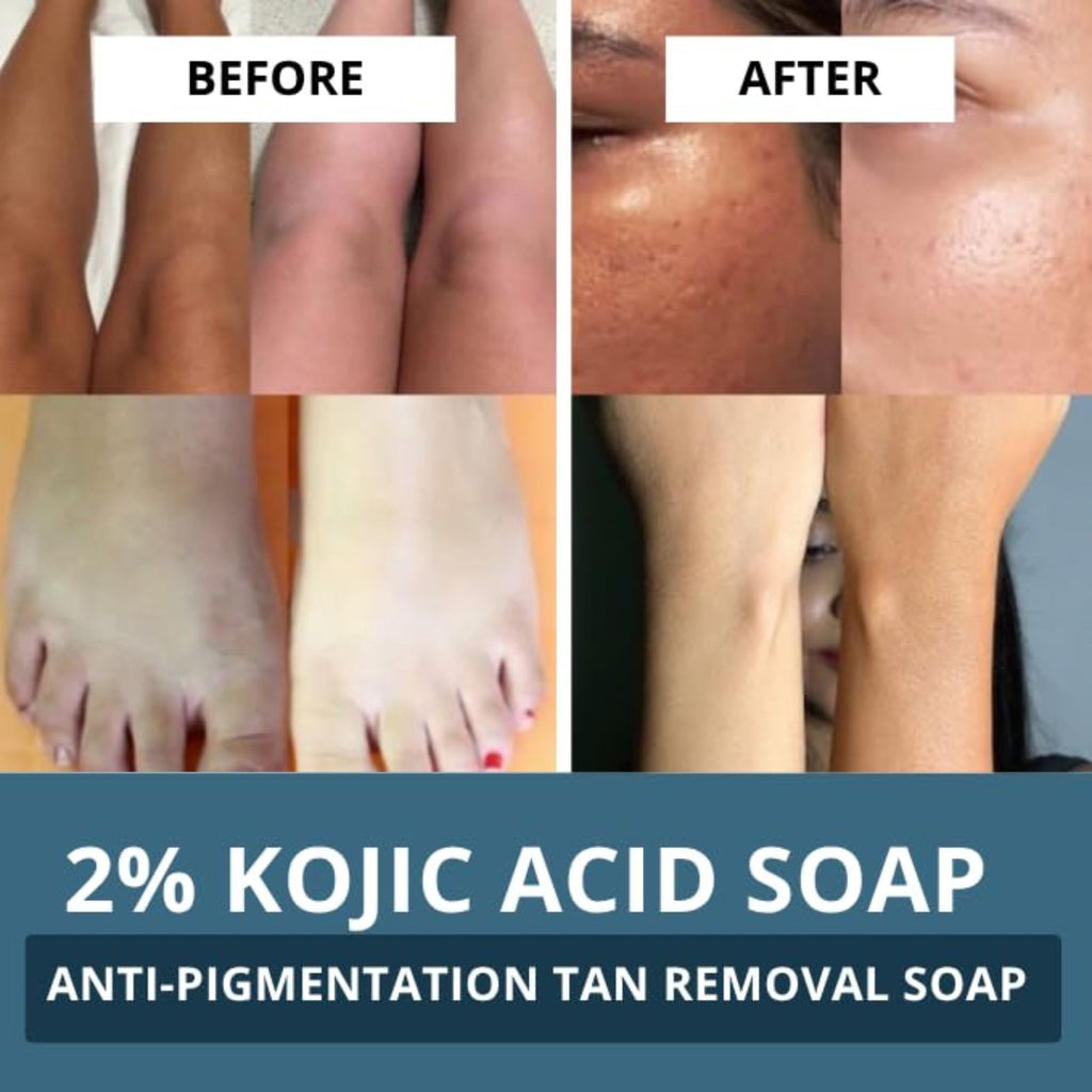 2% Kojic Acid Soap For Pigmentation, Dark Spots & Tan Removal