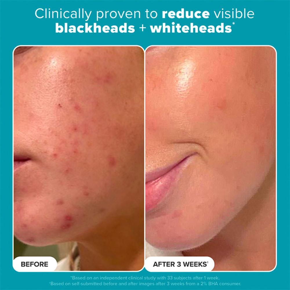 Skin Perfecting 2% Bha Liquid Exfoliant