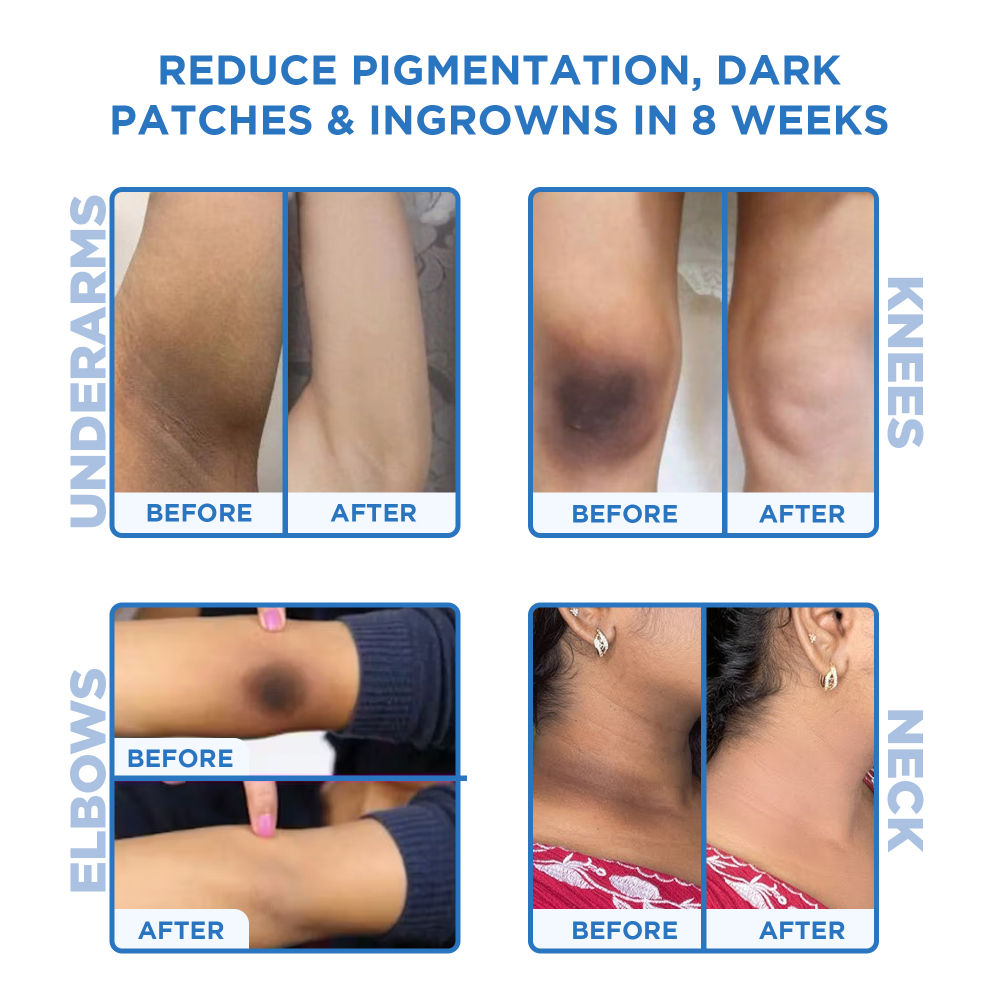 Instant Tan & Dead Skin Removal Exfoliating Gel For Women & Men - Tanning Dead Skin Remover