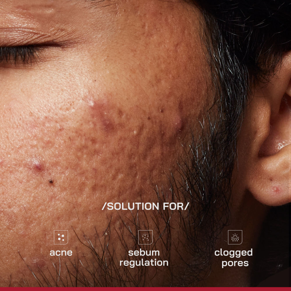 (PHD) 2% Salicylic Acid Anti-Acne Serum