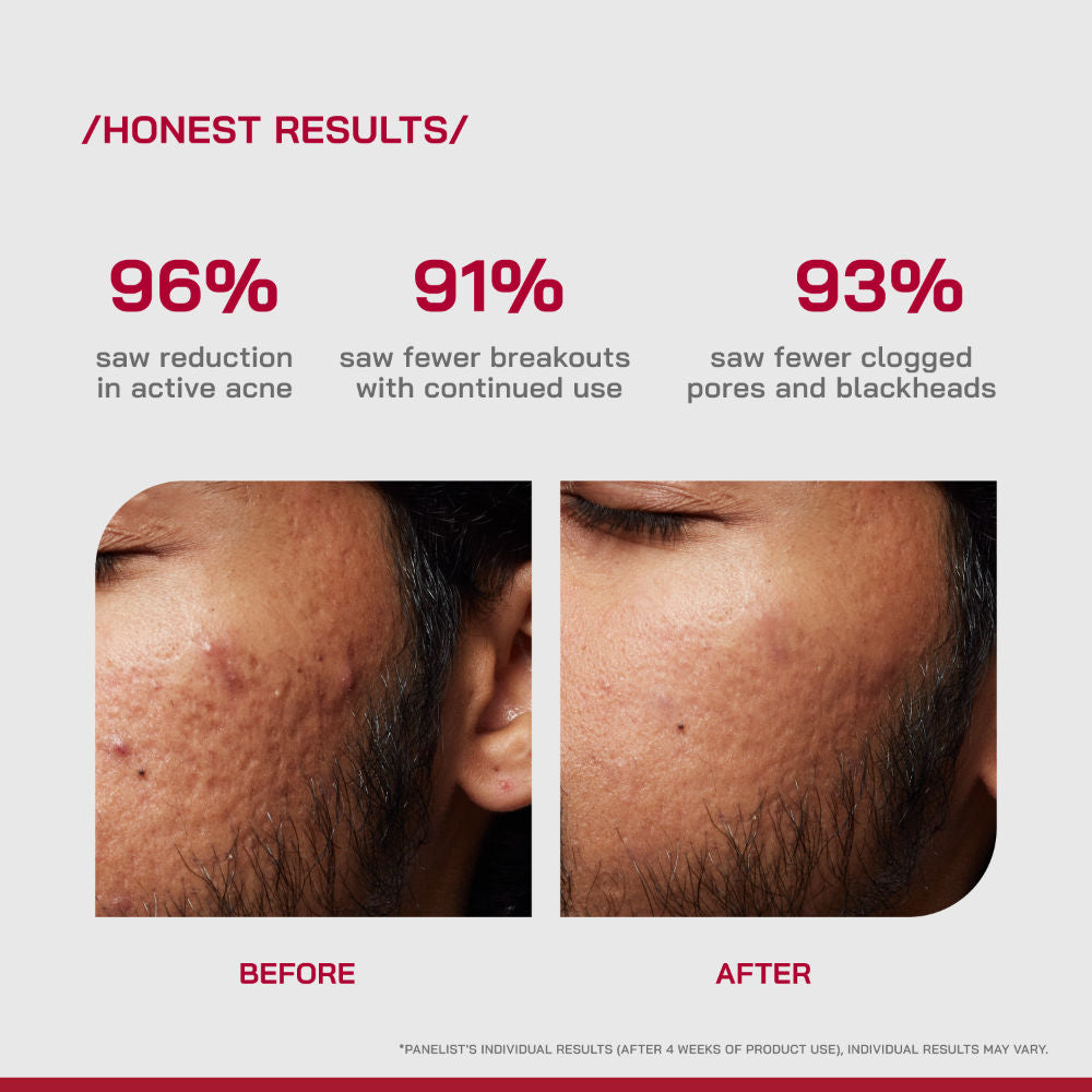 (PHD) 2% Salicylic Acid Anti-Acne Serum