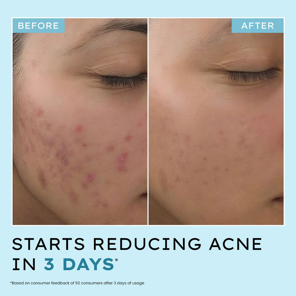 Anti Acne 10% Azelaic Acid 2% Salicylic Acid Face Serum, Tea Tree Extract, Fades Acne Marks
