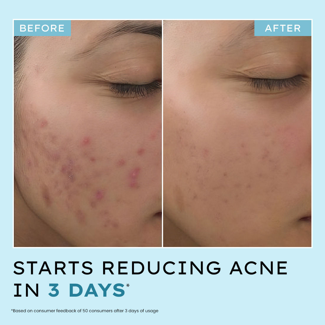 Anti Acne 10% Azelaic Acid 2% Salicylic Acid Face Serum, Tea Tree Extract, Fades Acne Marks