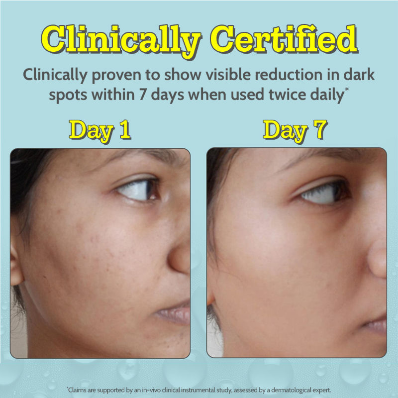 10% Vitamin C Face Serum Brightens Skin Treats Dark Spots & Hyperpigmentation