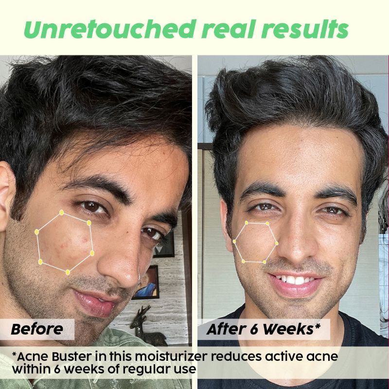 2% Niacinamide Jamun Moisturizer to Reduce Pimples for Oily & Acne Prone Skin, With Witch Hazel