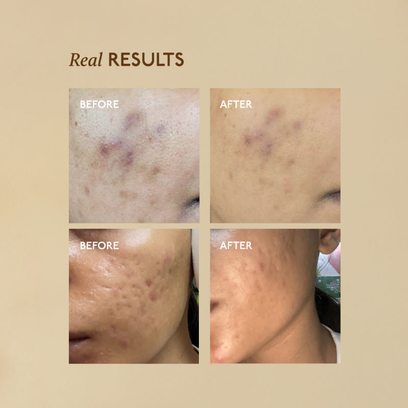 Advanced Dark Spot Pigmentation Face Serum for Men & Women with MelaMe Complex & Niacinamide