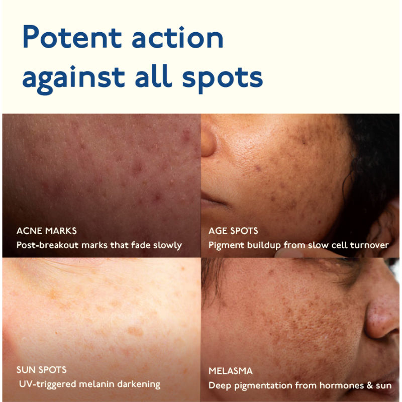 Advanced Dark Spot Gel for Pigmentation Acne Marks with MelaMe & Alpha Arbutin All Skin Type