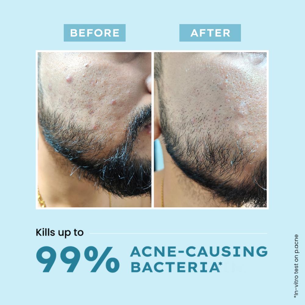 Clarifying Acne Cleanser With 2% Salicylic Acid, Anti-Acne Face Wash For Oil Control