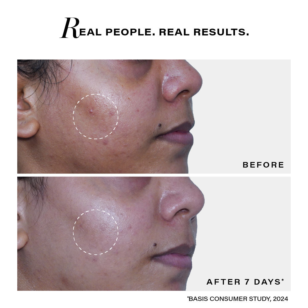Acne Clearing Foaming Cleanser