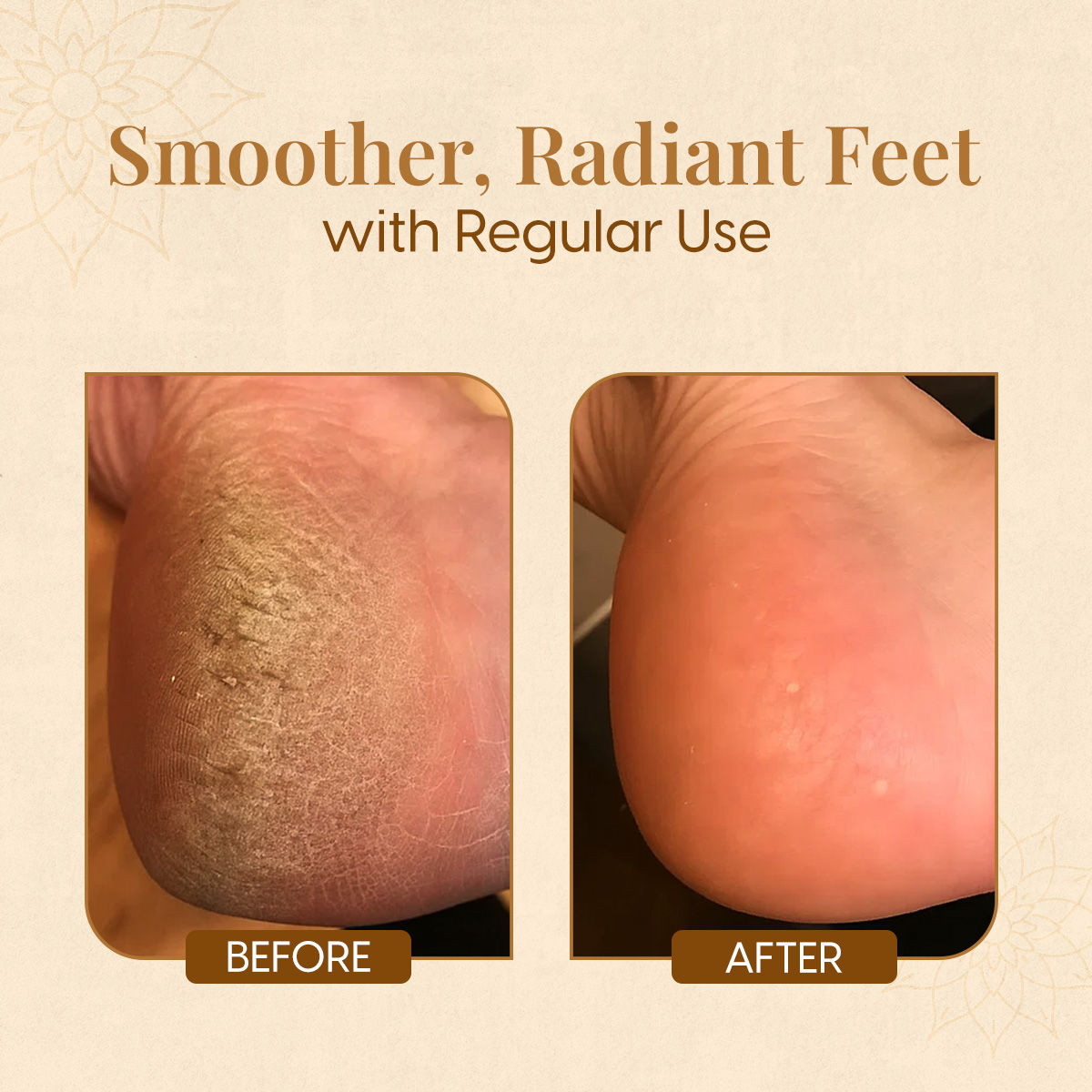 Foot Cream for Cracked Heels & Dry Feet with Moisturising Silicone Cotton Socks Callus Repair