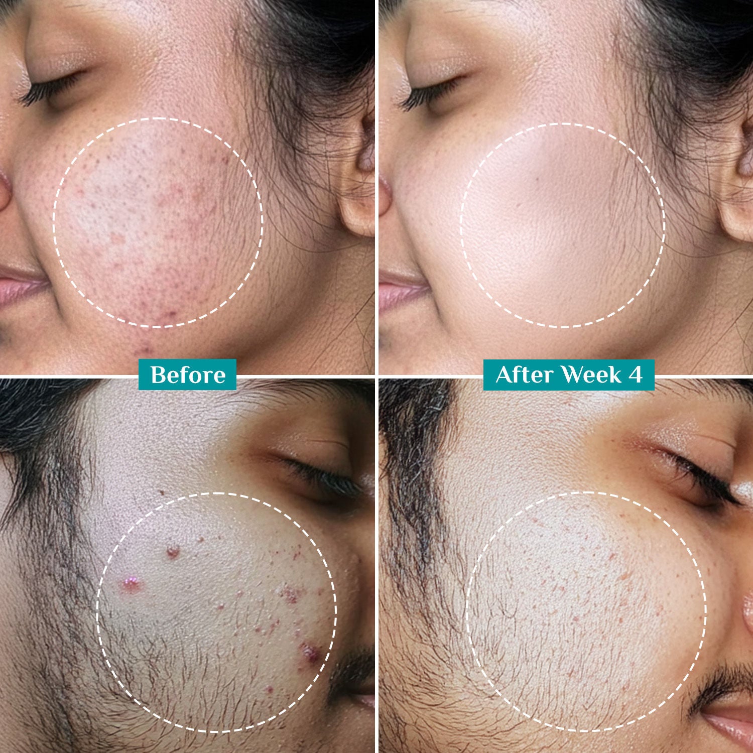 Salicylic & Glycolic Acid Anti Acne Serum