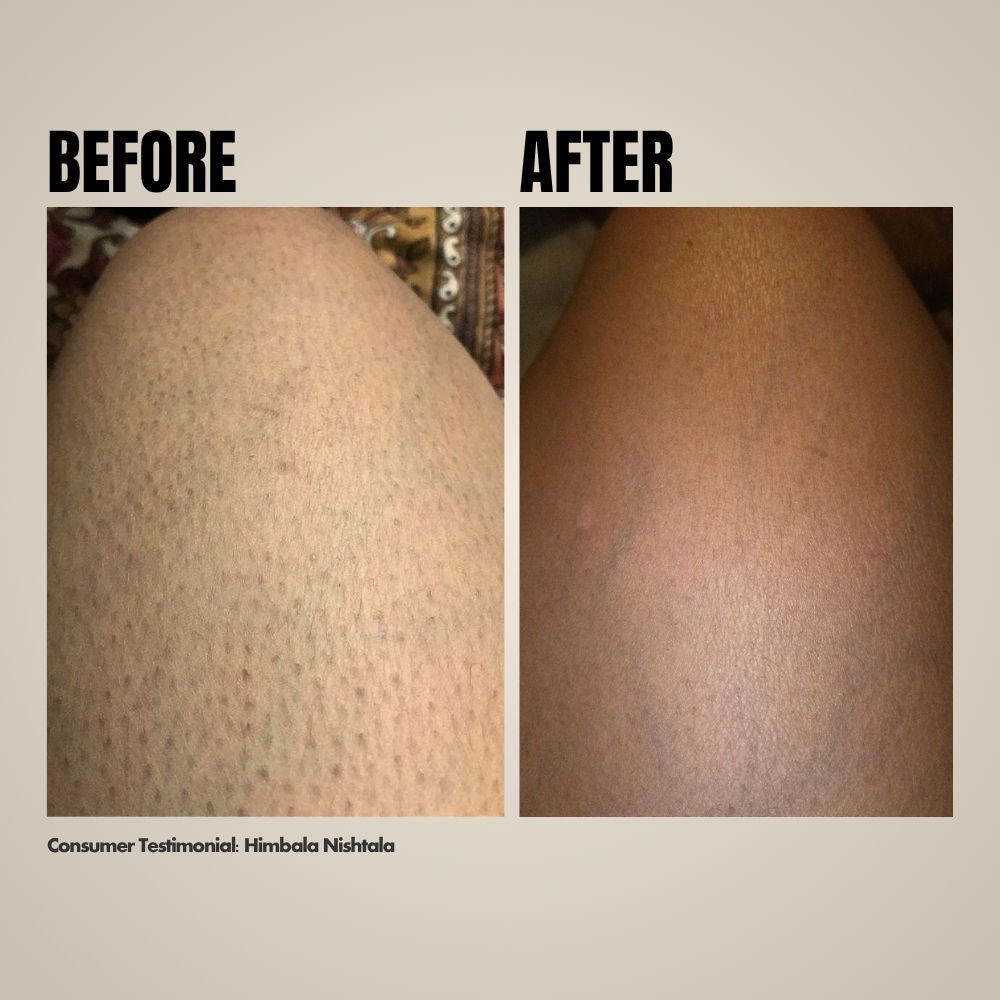 Ingrown Hair Treatment