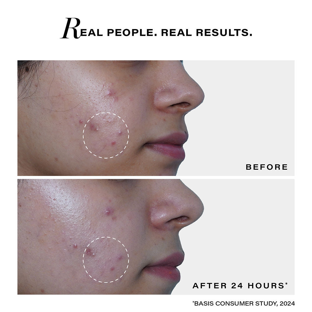 Acne Spot Corrector For Active Acne, Pimples And Whiteheads