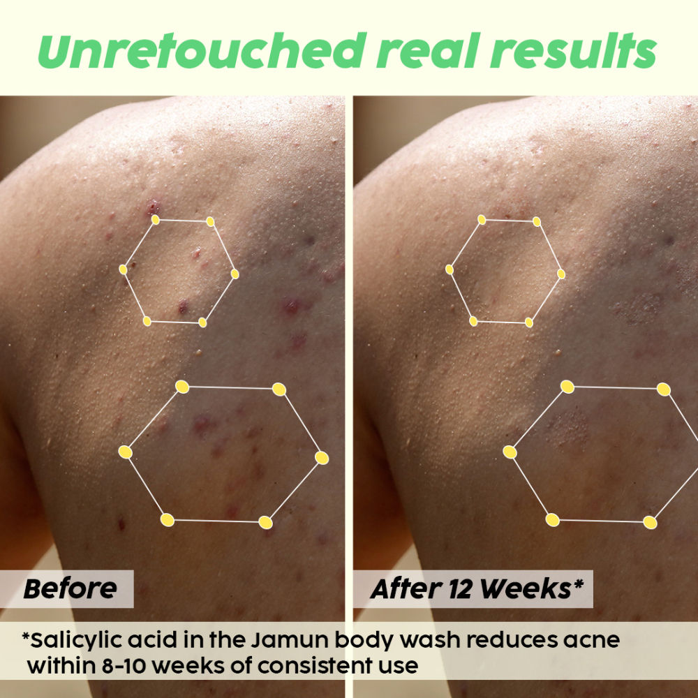2% Salicylic Acid Body Wash For Body Acne, Deeply Exfoliating Dead Skin Cells, Moisturizes Skin