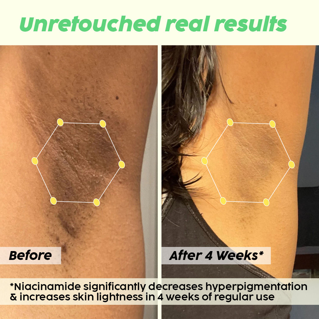 Pineapple Underarm Depigmentation Spray, For Lightening, Hyperpigmentation, Odour protection