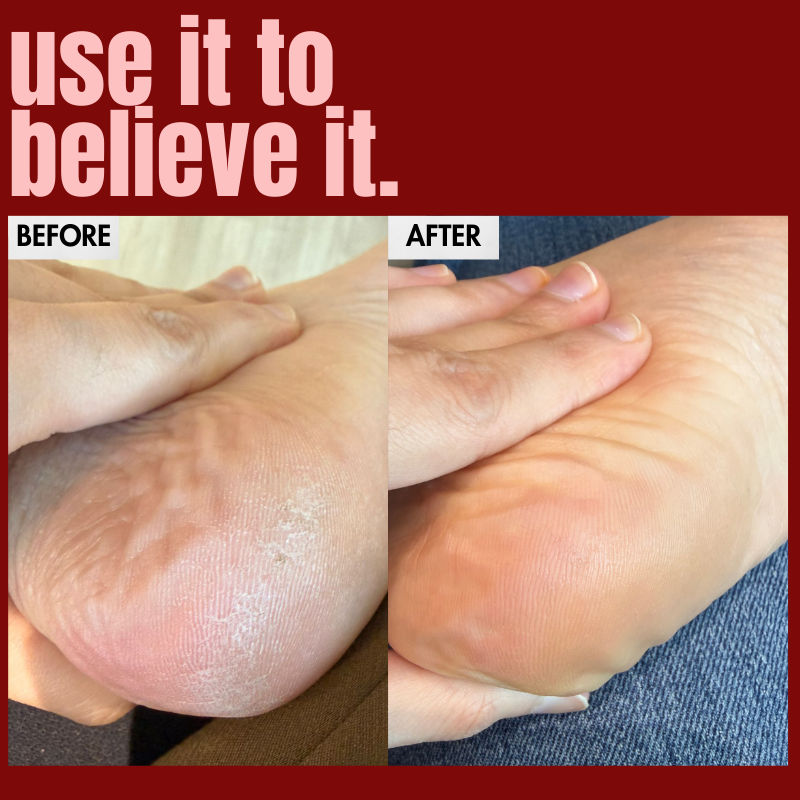 The Foot Balm For Dry Feet & Cracked Heels