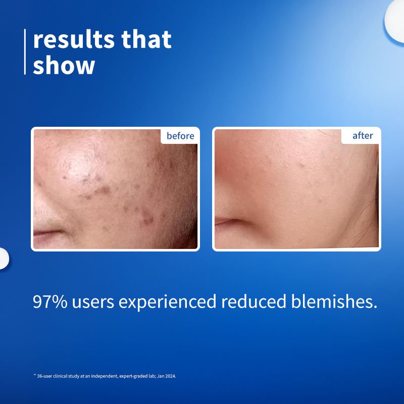 10% Niacinamide Brightening Face Serum with Rice Water & Ferment - Fades Blemishes & Acne Marks