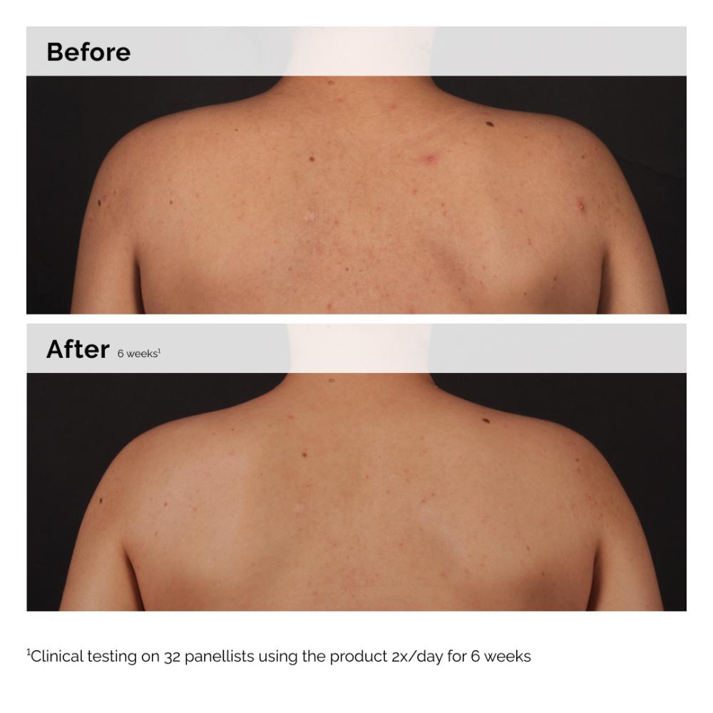 Salicylic Acid 0.5% Body Serum