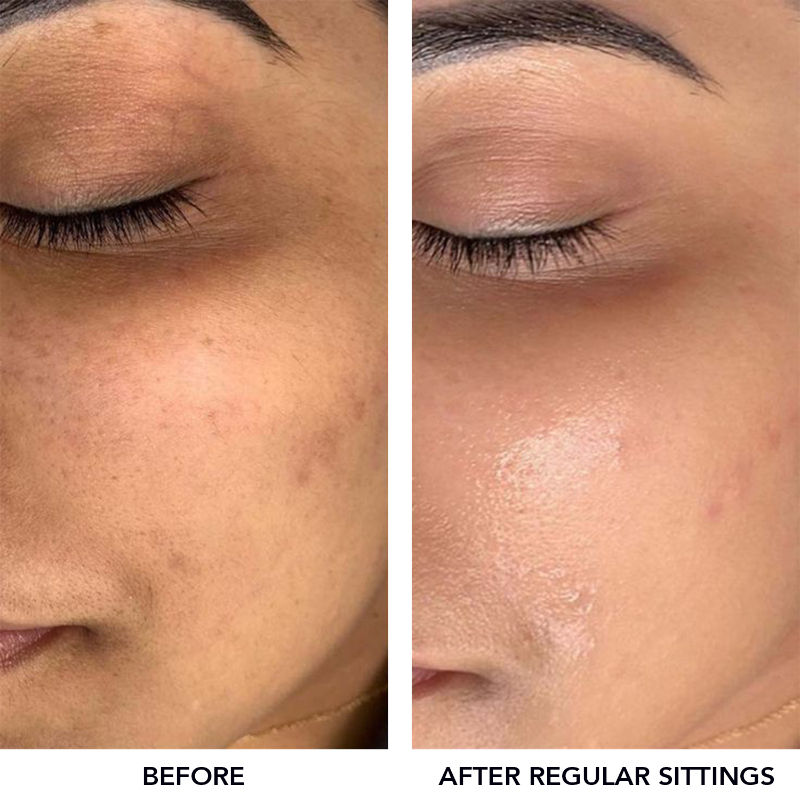 Meladerm Vitamin C Gel Bleach For Dullness Removal, Hydration & Glowing Skin, All Skin Types