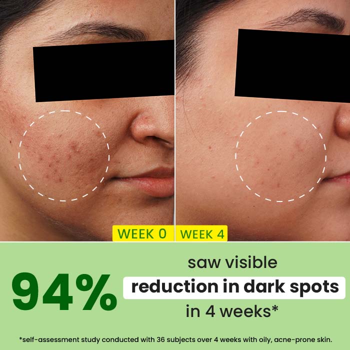 10% Niacinamide + Cica Face Serum For Oily, Acne Prone Skin & Dark Spots Reduction
