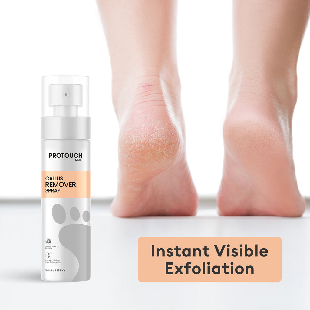 Callus Remover Spray