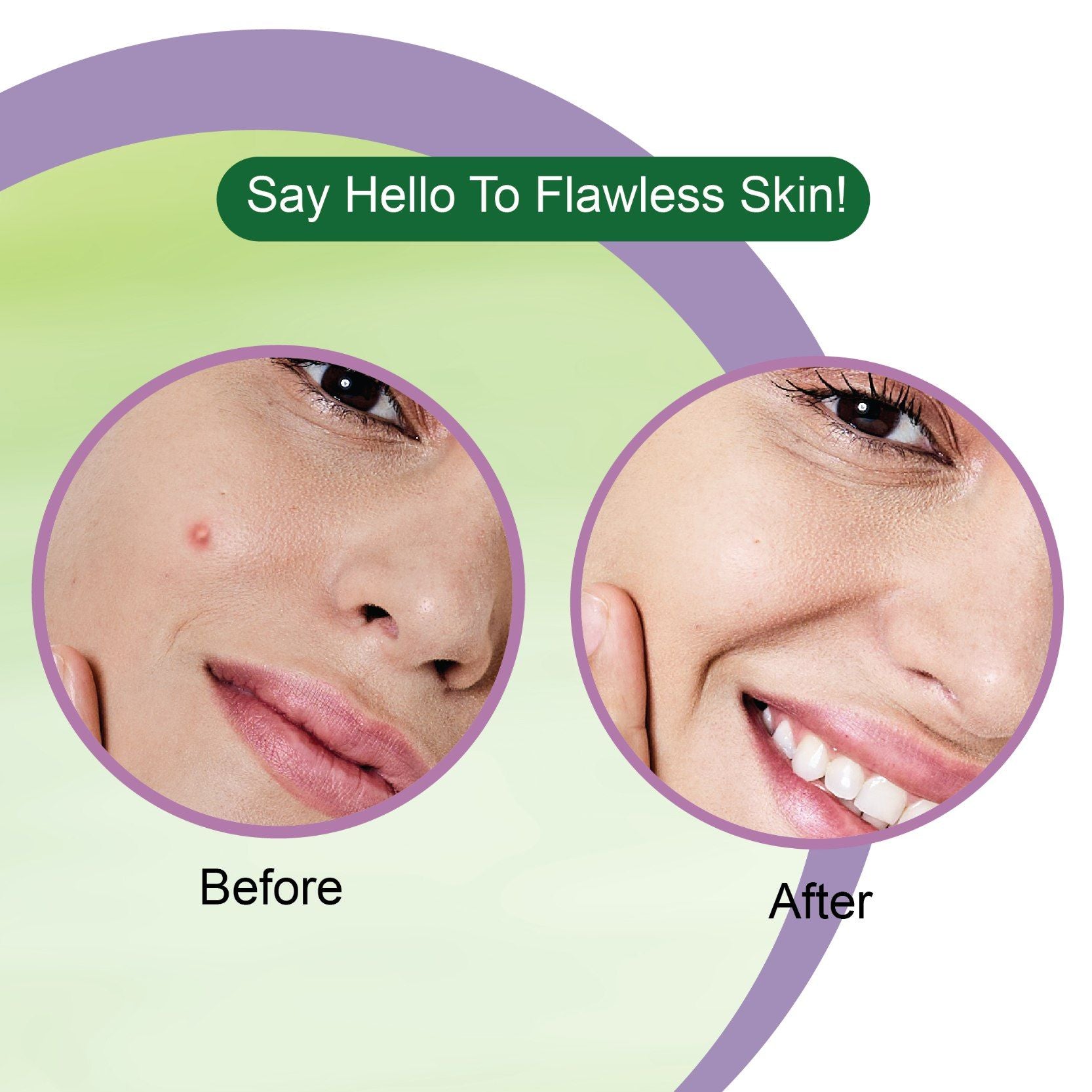 Neem Acne Pimple Patch