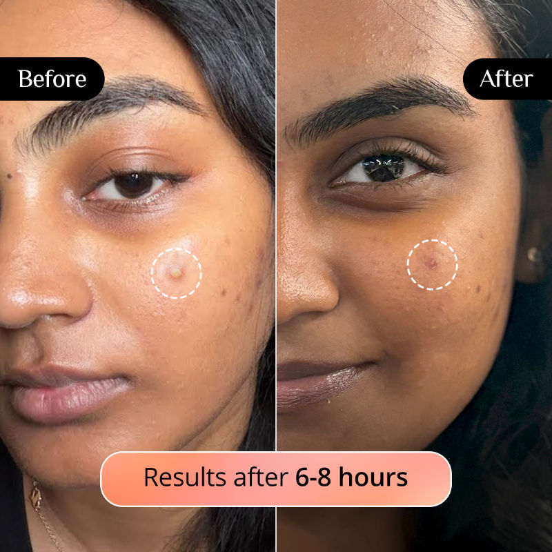 Pimple Patch for Acne, 72 Hydrocolloid and Salicylic Acid Patches, For All Skin Types