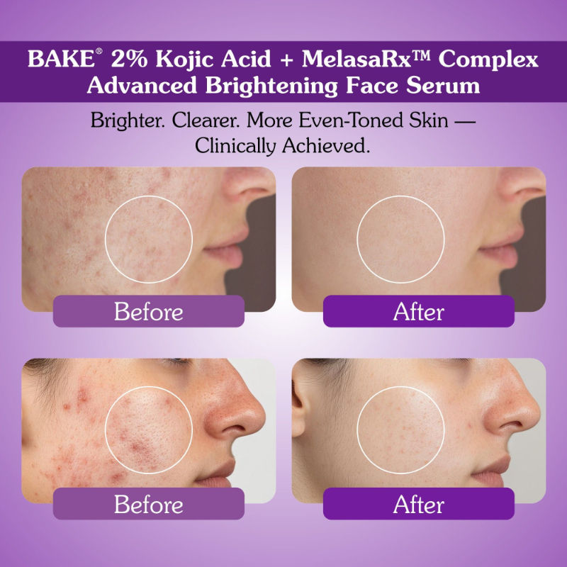 2% Kojic Acid Face Serum With Niacinamide For Pigmentation, Dark Spots & Uneven Skin Tone