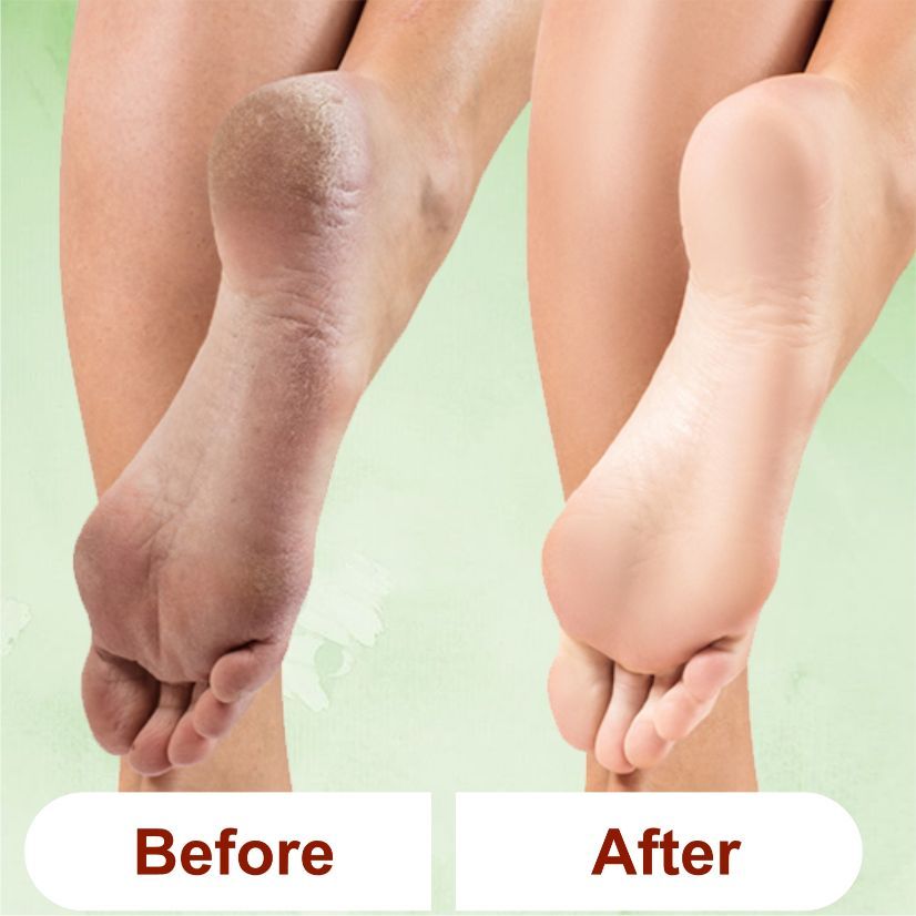 Anti Fungal Lemon Grass Foot Scrub For Home Pedicure With Natural Oils