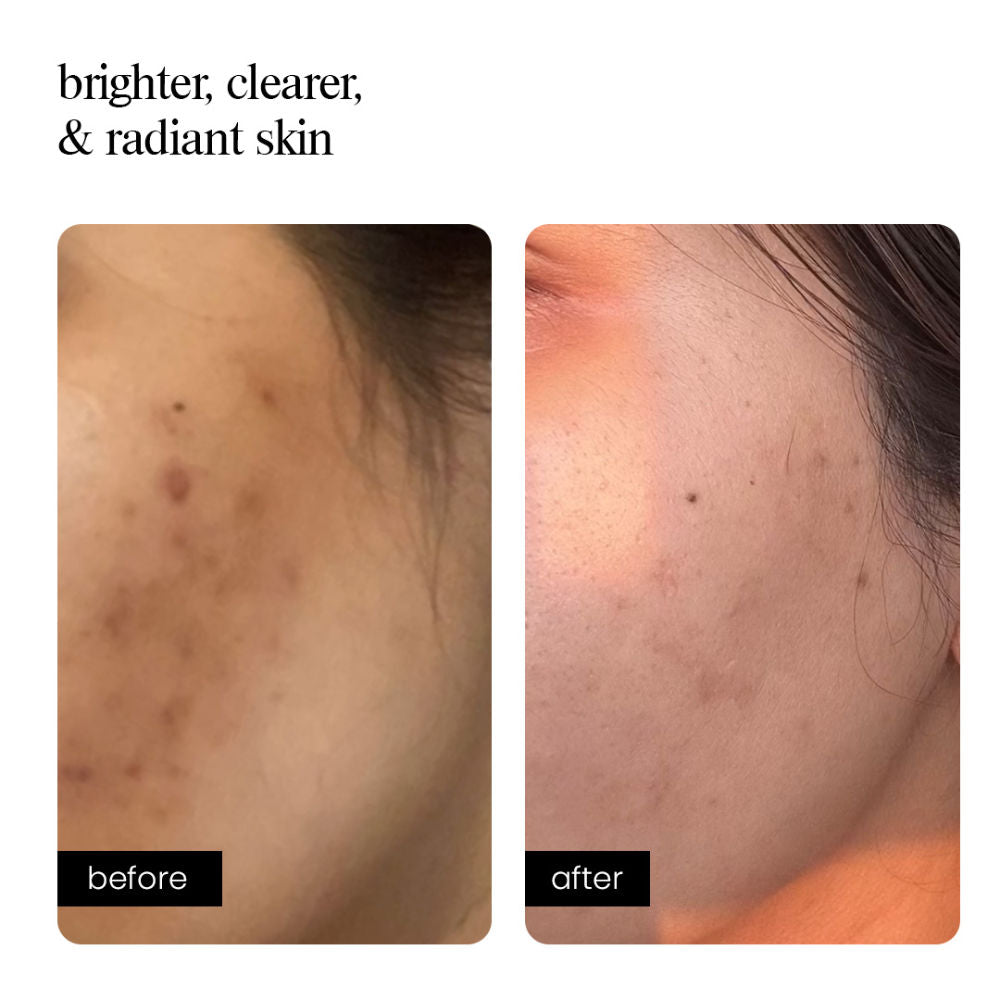 Correcting Concentrate – Treats Hyperpigmented Skin & Uneven Tone – Azelaic Acid, Niacinamide, Cica