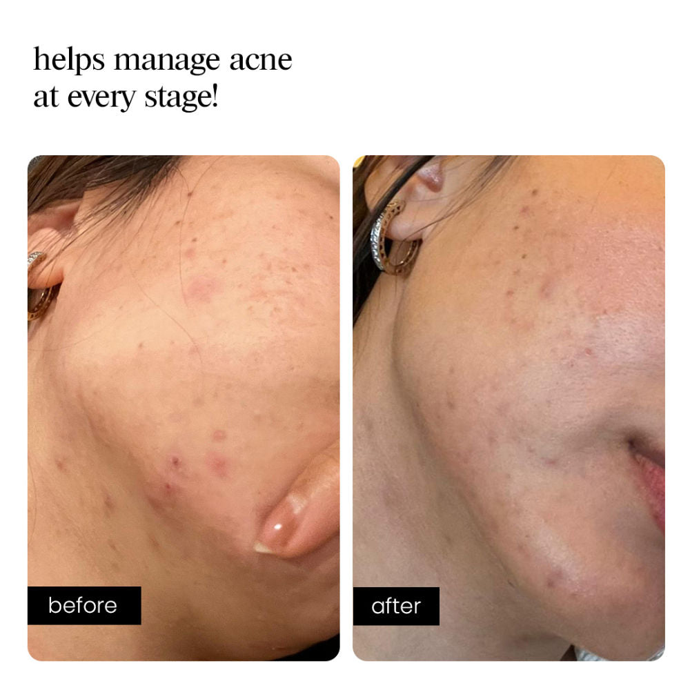 Clarifying Concentrate – Unclogs Pores, Controls Oil, Reduces Breakouts, Fades Acne Spots